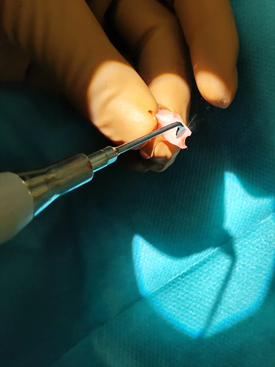 Porcszövet formálása a Piezosurgery Flex ultrahangos eszközzel műtét közben