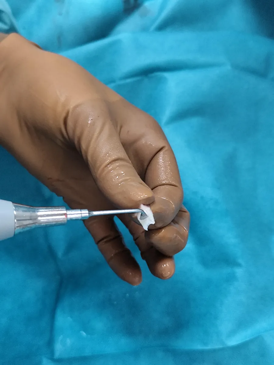 A Piezosurgery Flex ultrahangos munkavége porcgrafttal